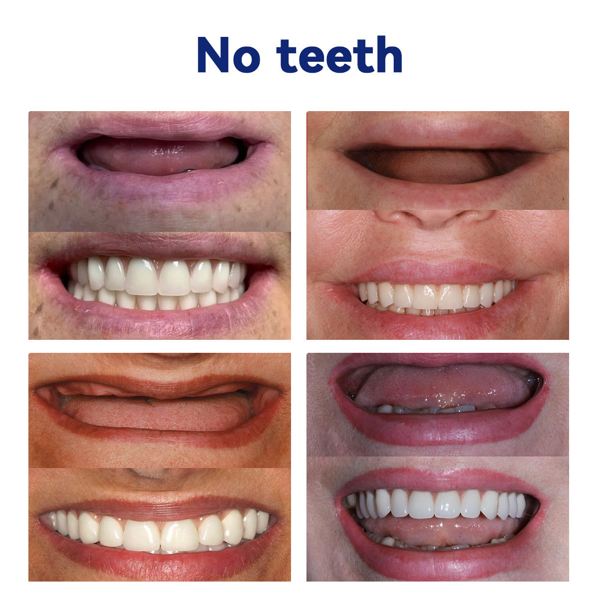 Bikenda™ Silicone Denture Ruler Set 🦷 (👩🔬 AMA Compliant, Approved by Professional Dentists) 🎄