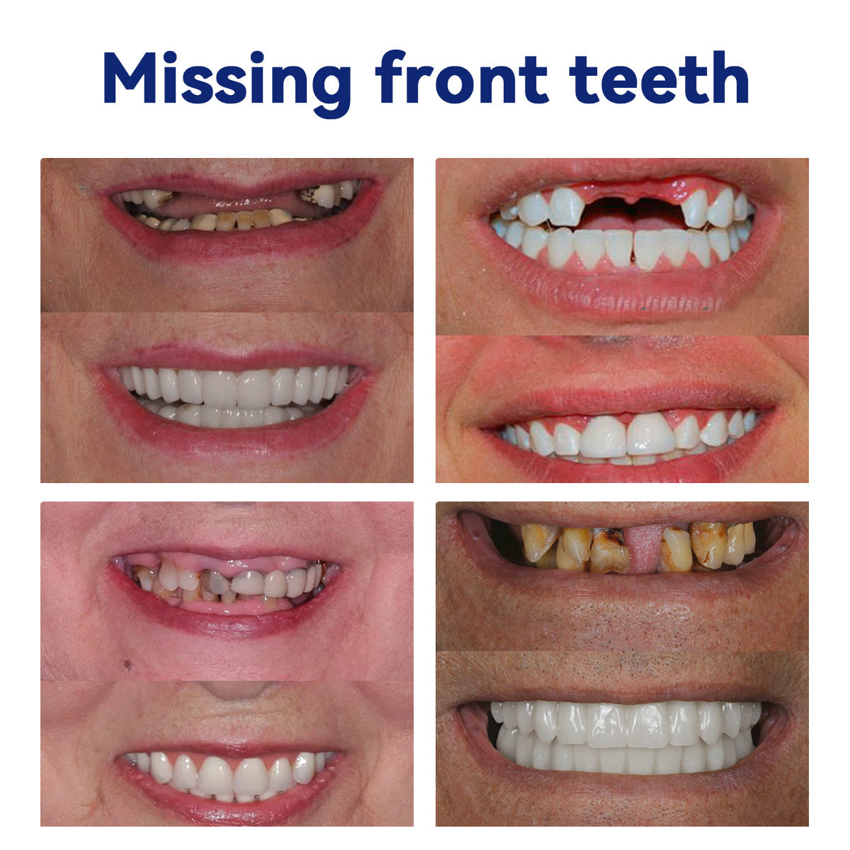 Bikenda™ Silicone Denture Ruler Set 🦷 (👩🔬 AMA Compliant, Approved by Professional Dentists) 🎄